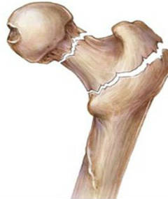 Болезнь Педжета деформирующее заболевание костей